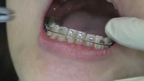 luồng dây cung và đóng nắp mắc cài sứ tự buộc Clippy-C TOMY