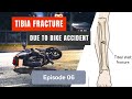 Tibia and Fibula fractured Ep. 06: Walking Improvements.