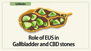 Linear EUS: Role of EUS in Gallbladder and CBD stones