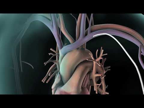 Vídeo: Valor Predictivo De Gamma-glutamiltransferasa Para Arritmias Ventriculares Y Mortalidad Cardiovascular En Pacientes Con Desfibrilador Cardioversor Implantable