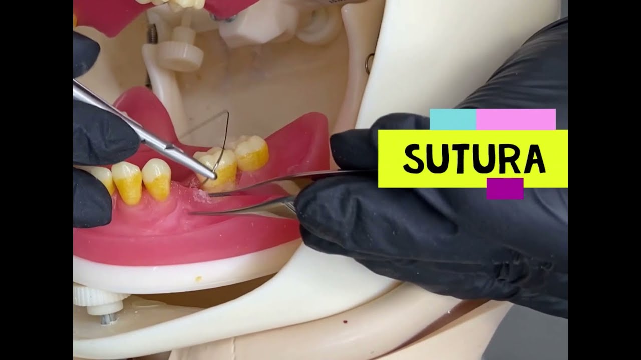 Cirurgia Periodontal - Aumento de coroa