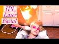 My IPL Photofacial Laser Experience & Results