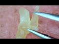 0297 keratin plug removal nose