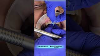 Gap Between Teeth? Watch This Smile Transformation! 😱🦷