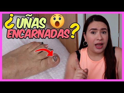 Video: ¿Se curará sola una uña encarnada? Respuestas a las preguntas frecuentes sobre las uñas encarnadas superiores