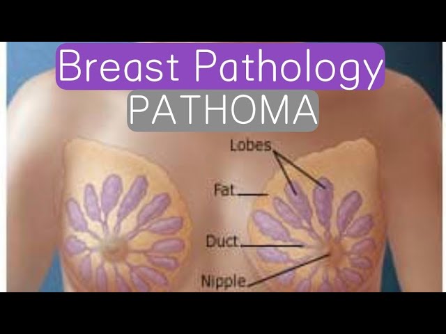 Breast Cancer - Clinical Pathology Flashcards