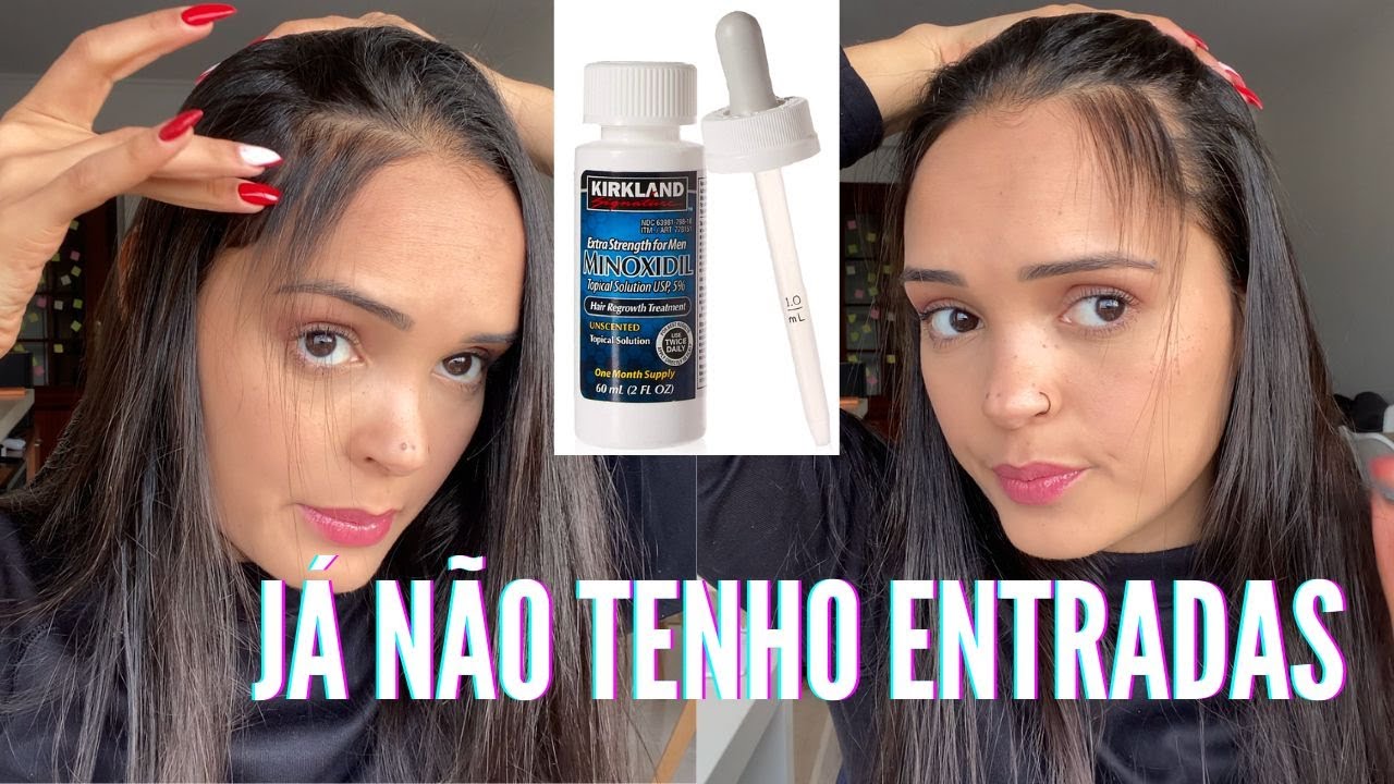 Qual O Melhor Minoxidil Para Cabelo Feminino? – QGUQI
