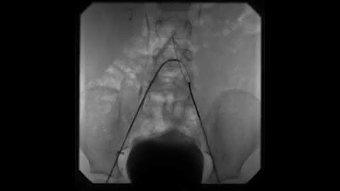 Snare retrieval of the wired broken catheter from the contralateral side