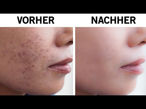 Video: Knoblauch Gegen Akne: Wie Viele Nelken Pro Tag Halten Dermatologen Fern?