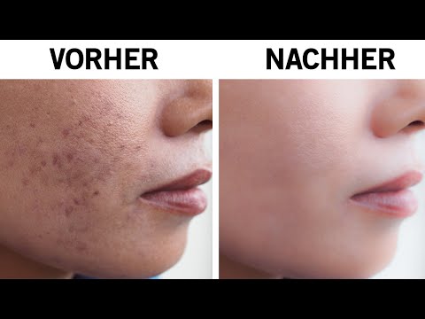 Video: Ayurveda Gegen Akne Und Pickel: 10 Wirksame Hausmittel