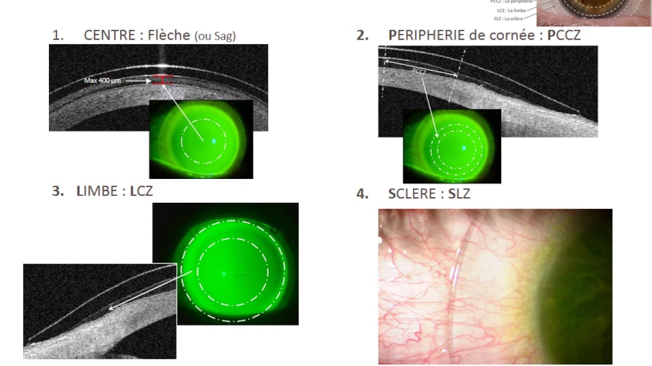 Lentilles Sclérales ICD
