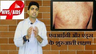 Early Symptoms Of HIV/AIDS II  एचआईवी और एड्स के शुरुआती लक्षण जान ले नहीं तो पछताओगे।