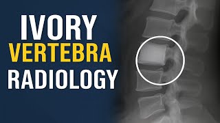 Ivory Vertebra Sign Key Imaging Features, Causes, Differential Diagnosis Radiology Simplified