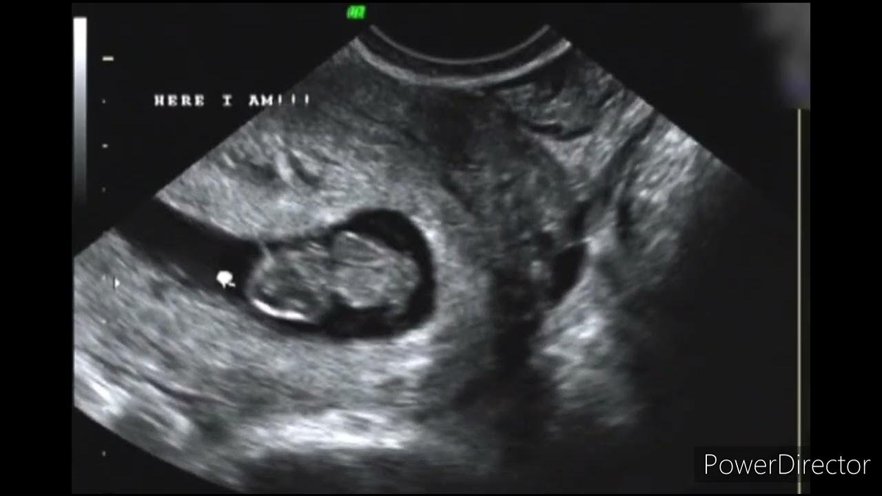 8-weeks-ultrasound-when-baby-s-heart-beat-comes-fetal-pole-yolk-sac