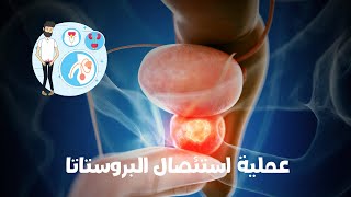 عملية استئصال البروستاتا كما لم تشاهدها من قبل|prostatectomy