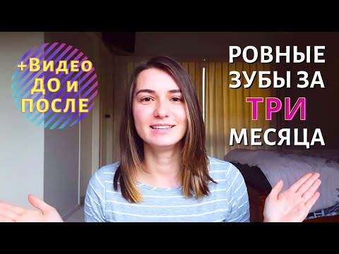 Выровняла зубы за 3 месяца в Новой Зеландии