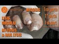 Mycosis and nail lysis [Part 1] Micosis y lisis ungueal [Parte 1] Micose [Podología Integral]