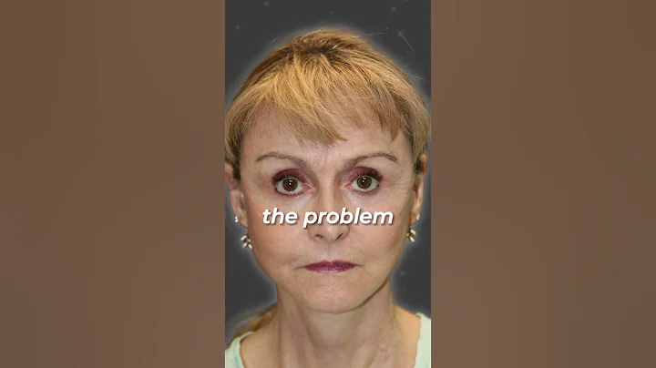 My Facelift Recovery Story #recovery #facelifts