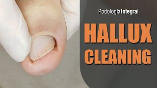 Hallux cleaning | 1st video