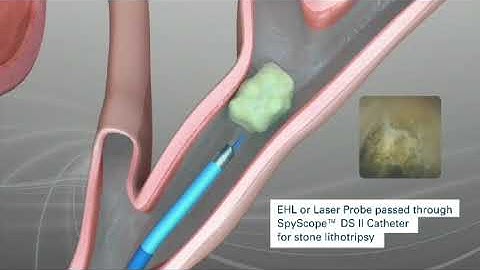 Boston Scientific spy glass cholangioscopy system - Mission Gastro Hospital, Satellite, Ahmedabad