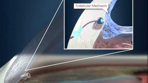 iStent Patient Video