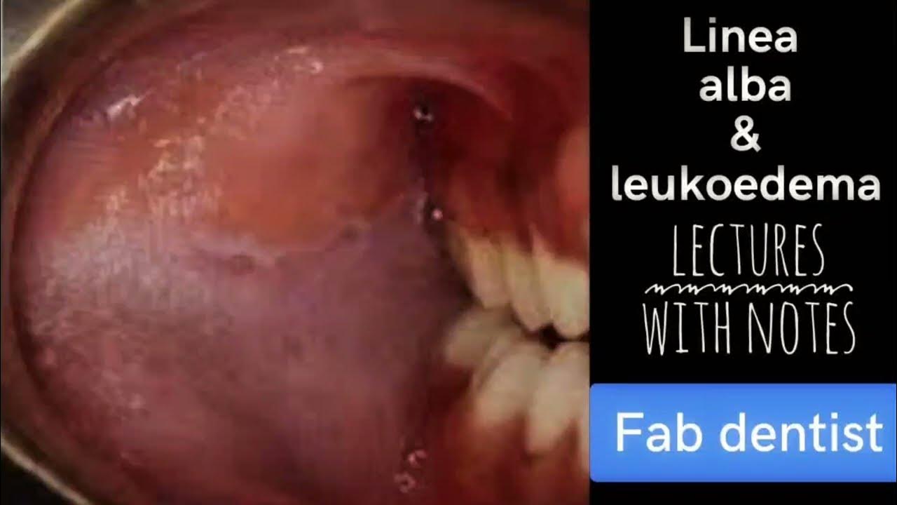 Origin Of Linea Alba