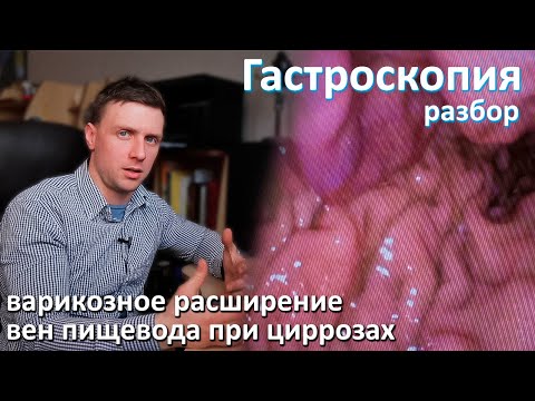 Варикозное расширение вен пищевода и желудка при циррозах печени. Разбор гастроскопии