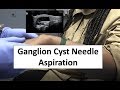 Needle Aspiration of a Ganglion Cyst