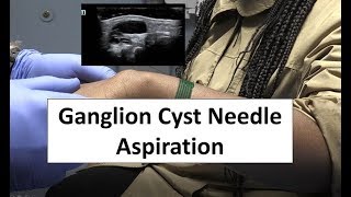 Needle Aspiration of a Ganglion Cyst