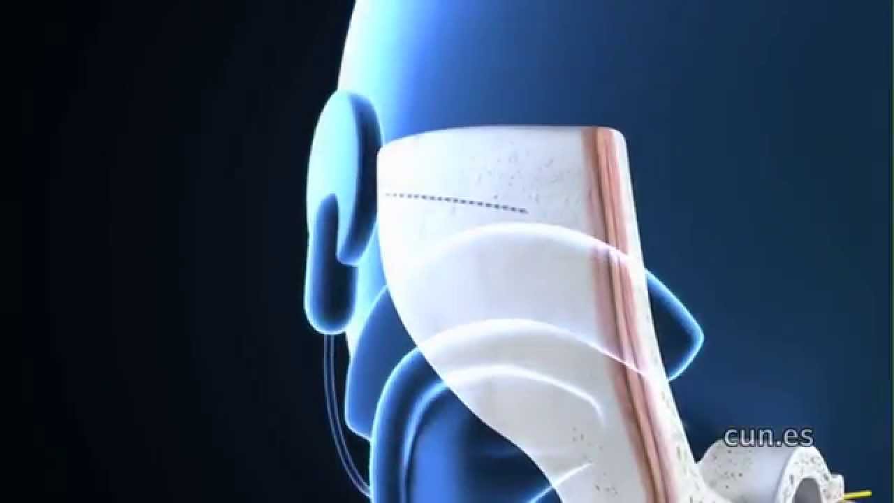 ¿Qué es un implante coclear? (Clínica Universidad de Navarra)