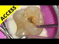 Max molar access ep1 of whole case