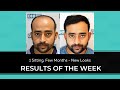 1 sitting few months   complete new looks after dhi hair transplant procedure