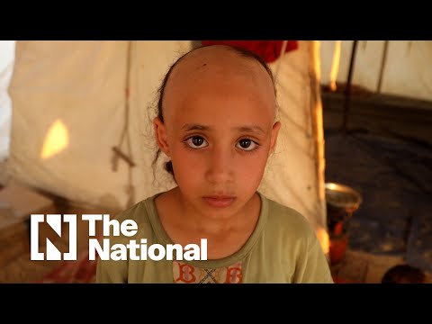 Palestinian child loses hair due to fear of Israeli air strikes