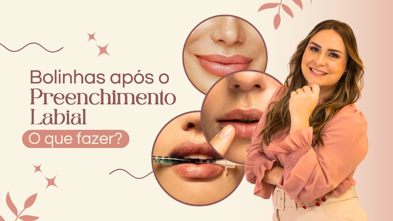 BOLINHAS APÓS O PREENCHIMENTO LABIAL