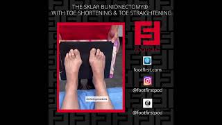 Bunion And Toe Shortening Surgery