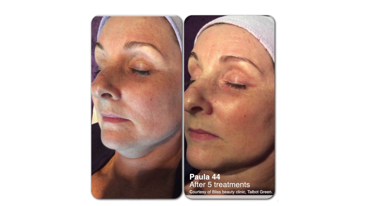 NeoGen Plasma Skin Treatments