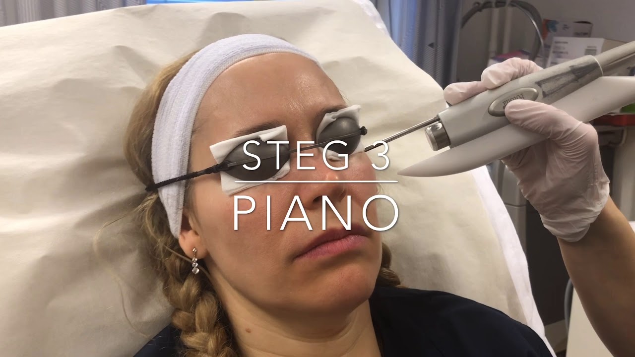 ansiktslyft med laser ansiktslyft med laser