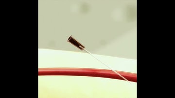 Radial artery puncture using the  Insyte and Angiocath  technique