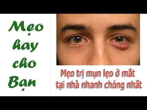 [Mẹo hay] Chữa mụn lẹo ở mắt hiệu quả chỉ cần 3 phút mỗi ngày với 6 cách dân gian này