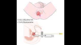 Transperineal Prostate Biopsy under Local Anaesthetics ( Software Fusion)
