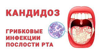 oral candidiasis