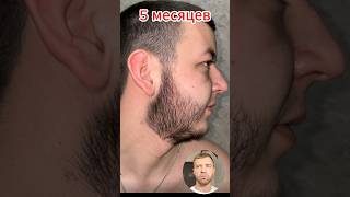 Запустил рост бороды с нуля в 20 лет / Андрей Борода / Миноксидил