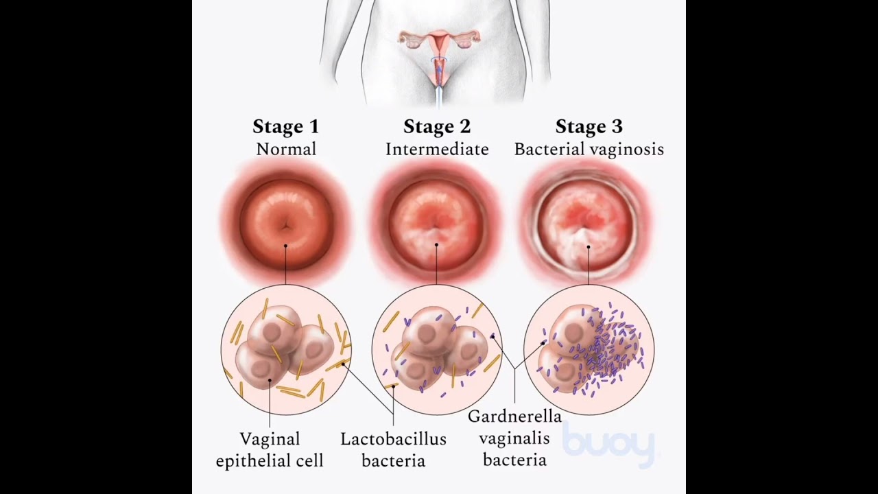 Cansoft-Cl how To Use | Cansoft-Cl Use in Hindi | Cansoft-Cl Vaginal Suppository | Price 💊 ✅