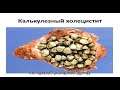 Хронический калькулезный холецистит