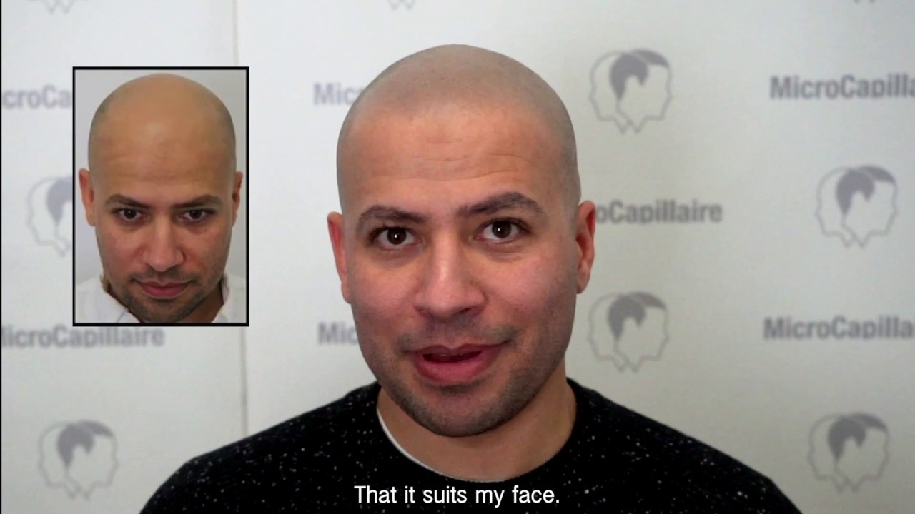 BEST scalp micropigmentation healed results | Clinique MicroCapillaire