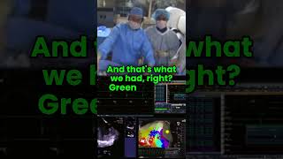 VT mapping with HD Grid catheter