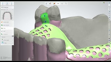 Dental Lab Life: Scanning and Designing a Removable Partial Denture Using 3Shape