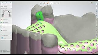 Dental Lab Life: Scanning and Designing a Removable Partial Denture Using 3Shape