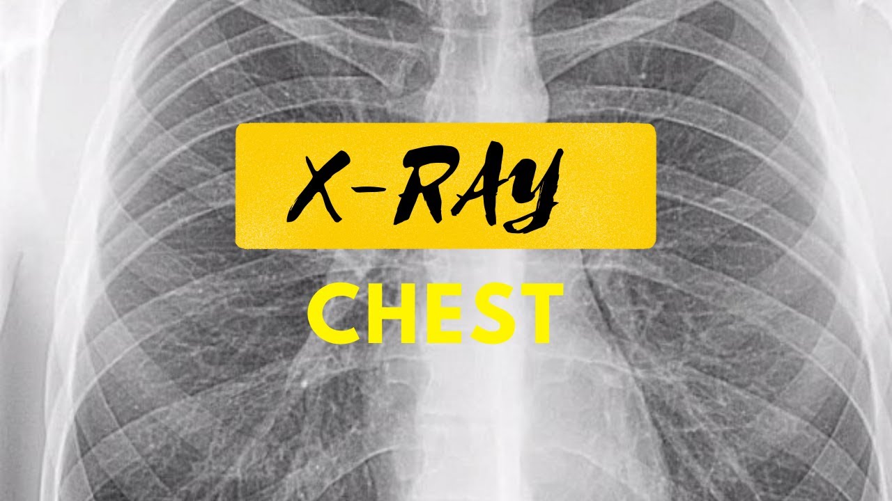 Acute Bronchitis Radiological Survey Images Things Found In An X