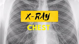 Acute Bronchitis | Radiological Survey Images | Things Found In An X Ray | X-ray of Chest |